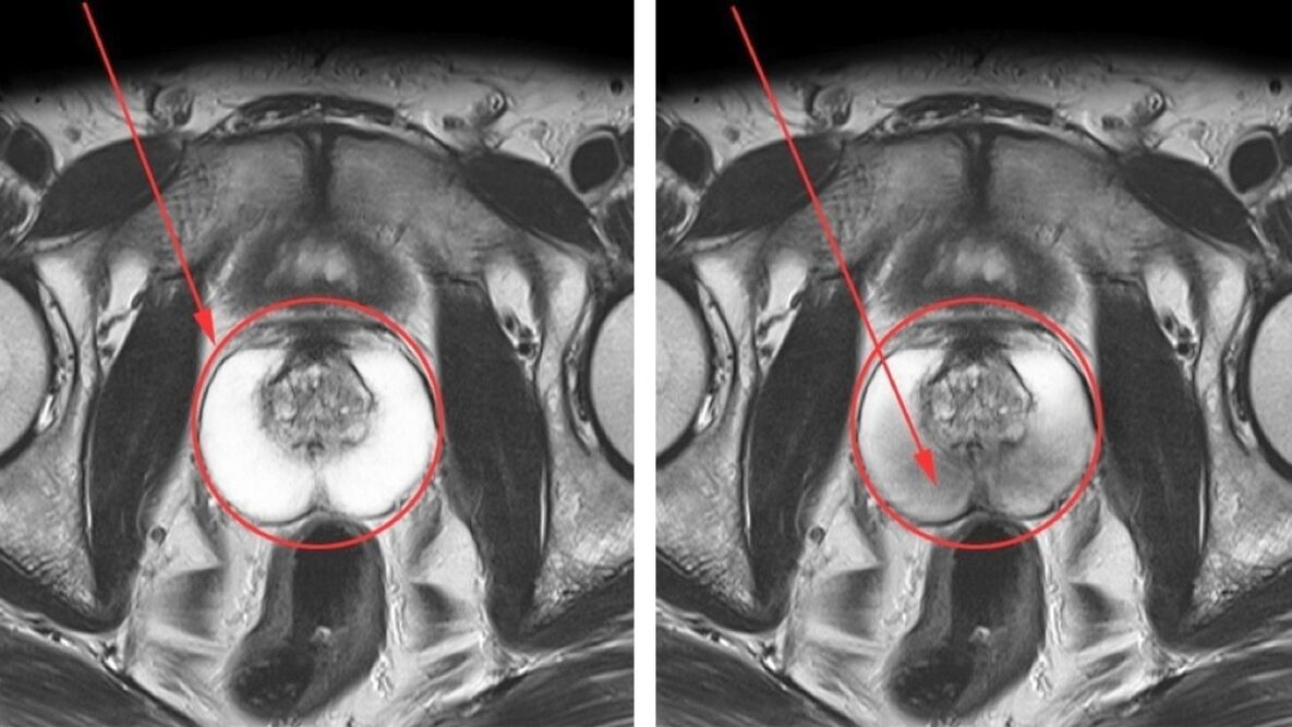 УЗИ при хроническом простатите – здоровая простата (слева) и воспаленная простата (справа)